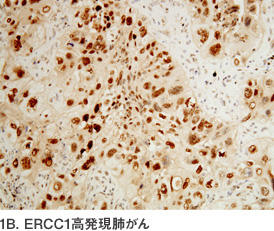 1B. ERCC1高発現肺がん