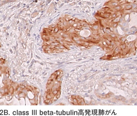 class III beta-tubulin高発現肺がん