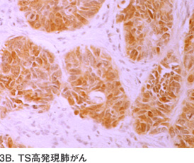 3B. TS高発現肺がん