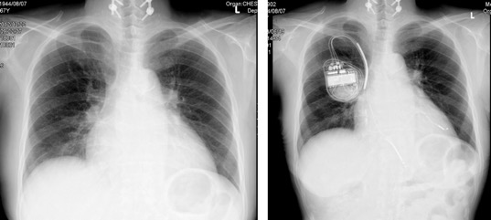 図８：心臓再同期療法（治療前：左、治療後：右）
