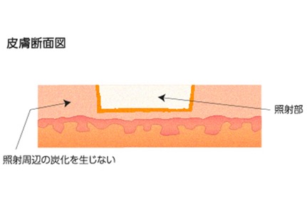 皮膚断面図