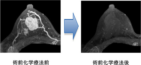 術前化学療法