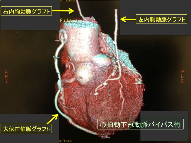 冠動脈バイパス術後の造影CT画像"