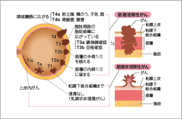 治療について 泌尿器科 大阪 北野病院