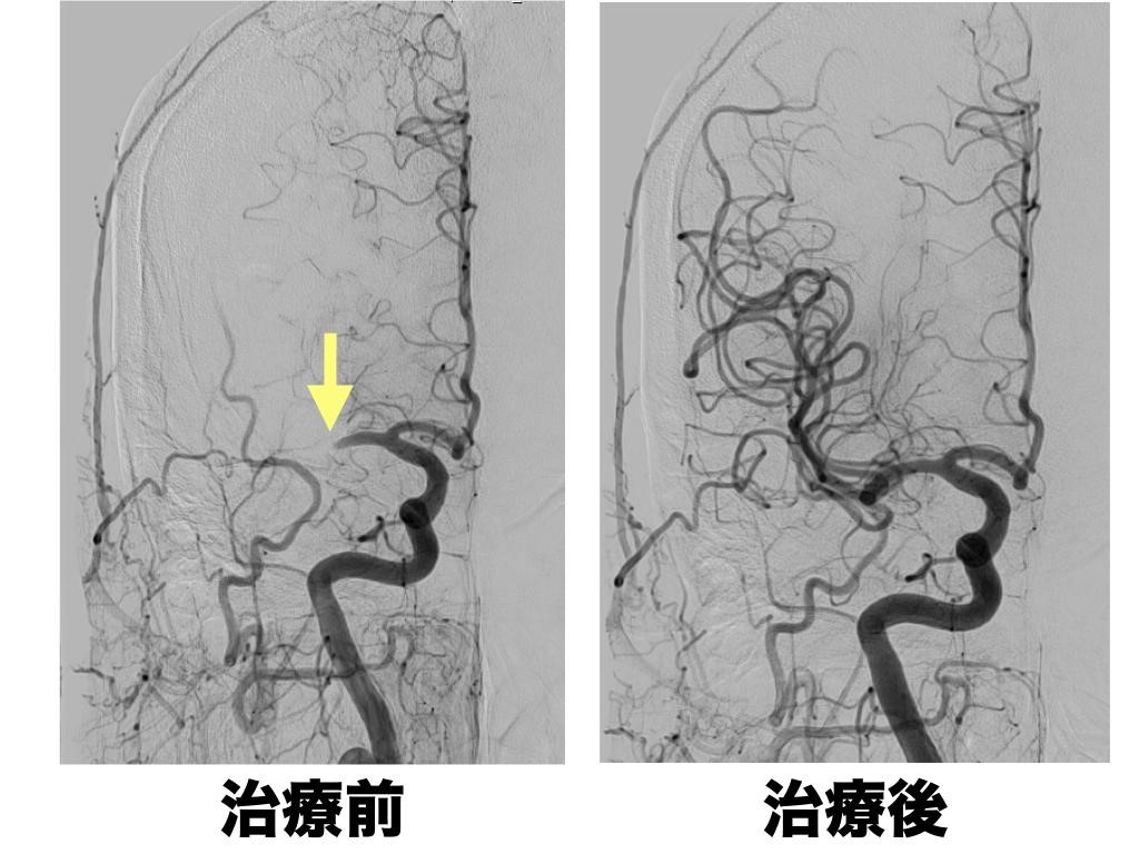 脳梗塞治療前後