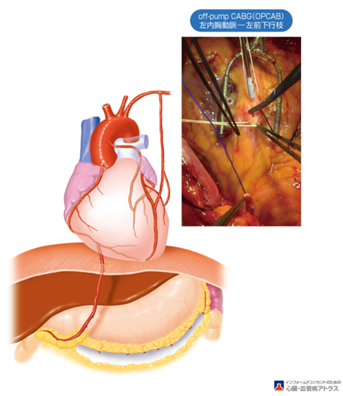 スタビライザーを用いたOPCAB（左内胸動脈―左冠動脈前下行枝バイパス手術）とそのシェーマ