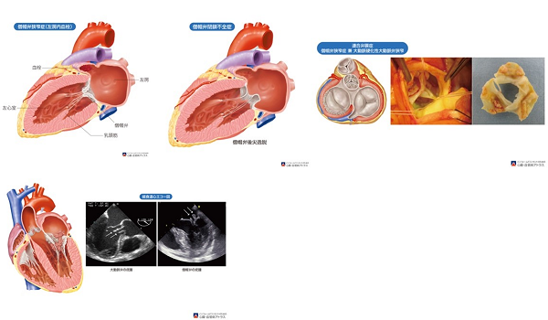 心臓弁膜症（出典 山科・近森・荻野監修 インフォームドコンセントのための心臓•血管病アトラス）