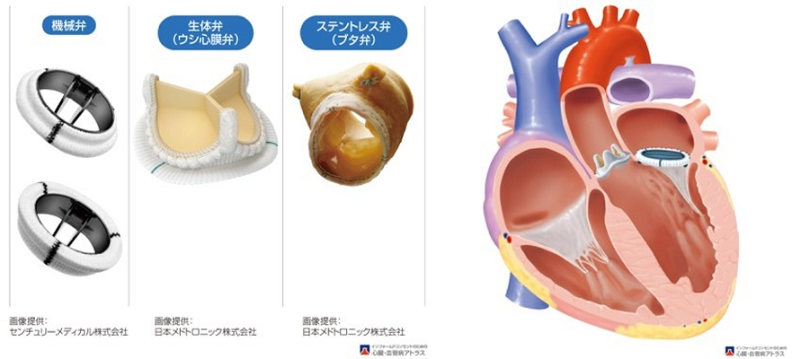 人工弁（左：機械弁、右：生体弁）および人工弁置換術（大動脈弁：生体弁、僧帽弁：機械弁）（出典 山科・近森・荻野監修 インフォームドコンセントのための心臓•血管病アトラス）