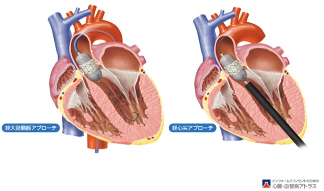経カテーテル的大動脈弁留置・置換術（TAVI・TAVR）（出典 山科・近森・荻野監修 インフォームドコンセントのための心臓•血管病アトラス）