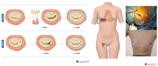 僧帽弁形成術（出典 山科・近森・荻野監修 インフォームドコンセントのための心臓•血管病アトラス）