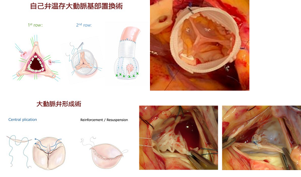 大動脈弁形成術および自己弁温存大動脈基部置換術（術中写真は前任地での症例）