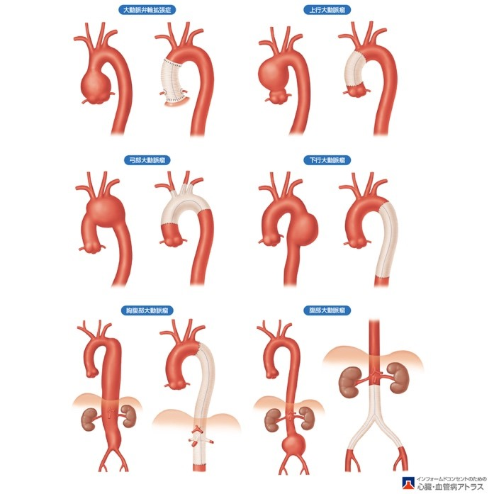 胸部・腹部大動脈瘤と人工血管置換術（出典 山科・近森・荻野監修 インフォームドコンセントのための心臓•血管病アトラス）