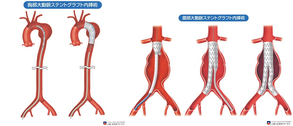胸部・腹部ステントグラフト内挿術（TEVAR・EVAR）（出典 山科・近森・荻野監修 インフォームドコンセントのための心臓•血管病アトラス）