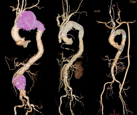 ハイブリッド大動脈治療（外科手術＋ステントグラフト内挿術）：前任地での経験