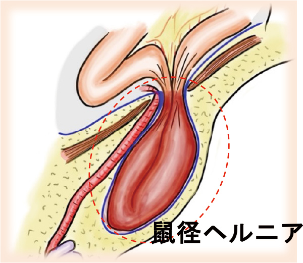 鼡径ヘルニア