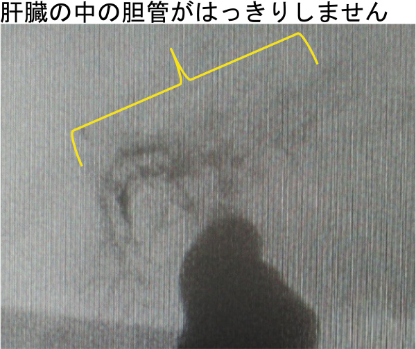 手術時の胆道造影検査