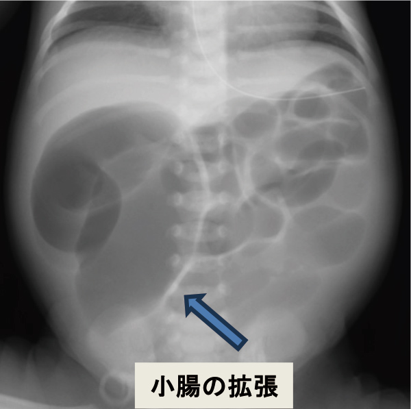 小腸の拡張