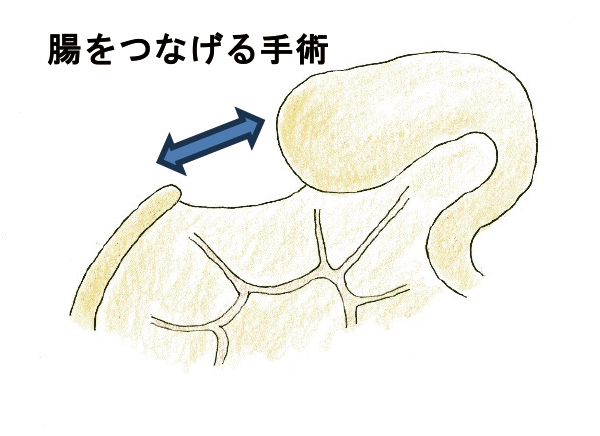 腸をつなげる手術