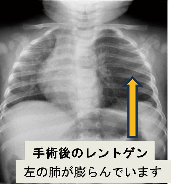 手術後のレントゲン 左の肺が膨らんでいます
