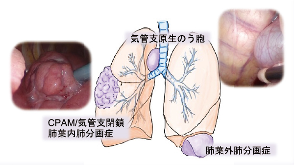 先天性のう胞性肺疾患