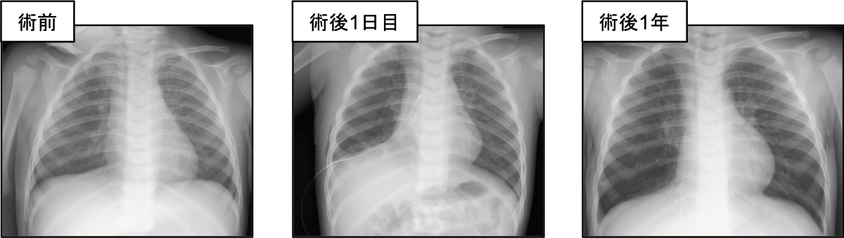 右下葉切除術後。手術後すぐは右肺が小さくなっていますが、1年後には左右差がなくなっています。
