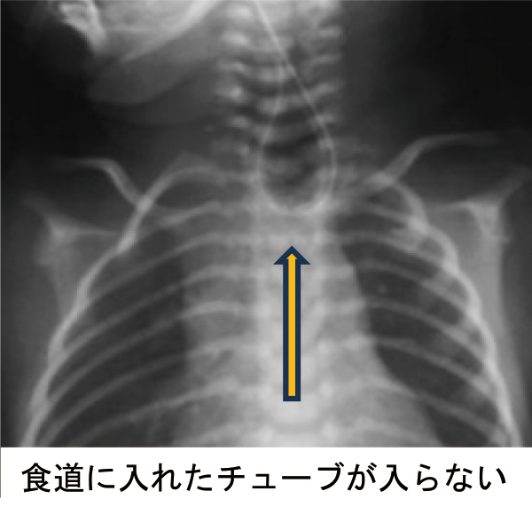 食道に入れたチューブが入らない
