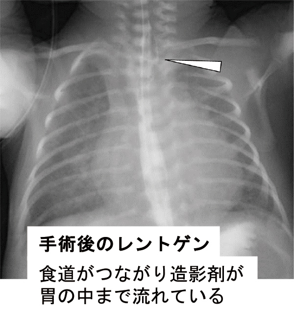 手術後のレントゲン　食道がつながり造影剤が胃の中まで流れている