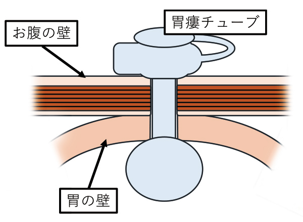 おなかの壁と胃の壁をくっつけてそこにチューブを通します