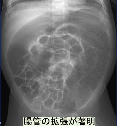 腸管の拡張が著明