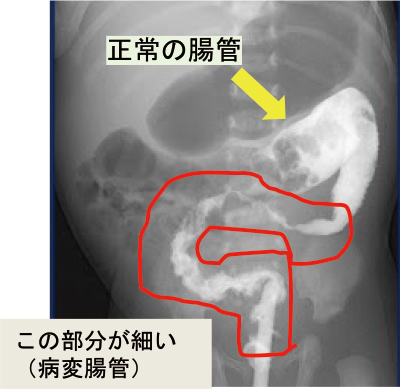 この部分が細い （病変腸管）