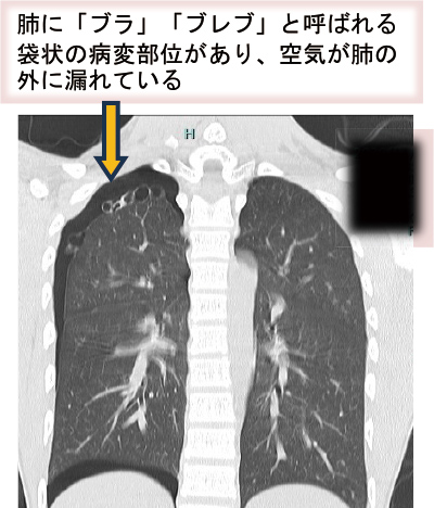 肺に「ブラ」「ブレブ」と呼ばれる 袋状の病変部位があり、空気が肺の 外に漏れている