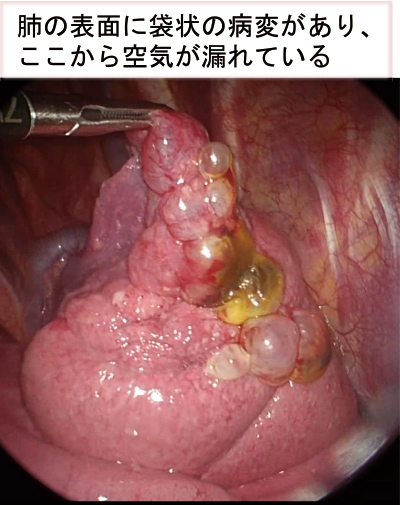肺の表面に袋状の病変があり、 ここから空気が漏れている