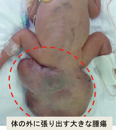 体の外に張り出す大きな腫瘍