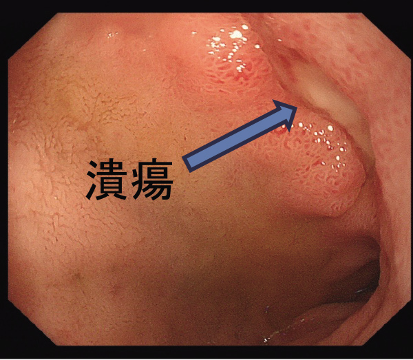十二指腸潰瘍