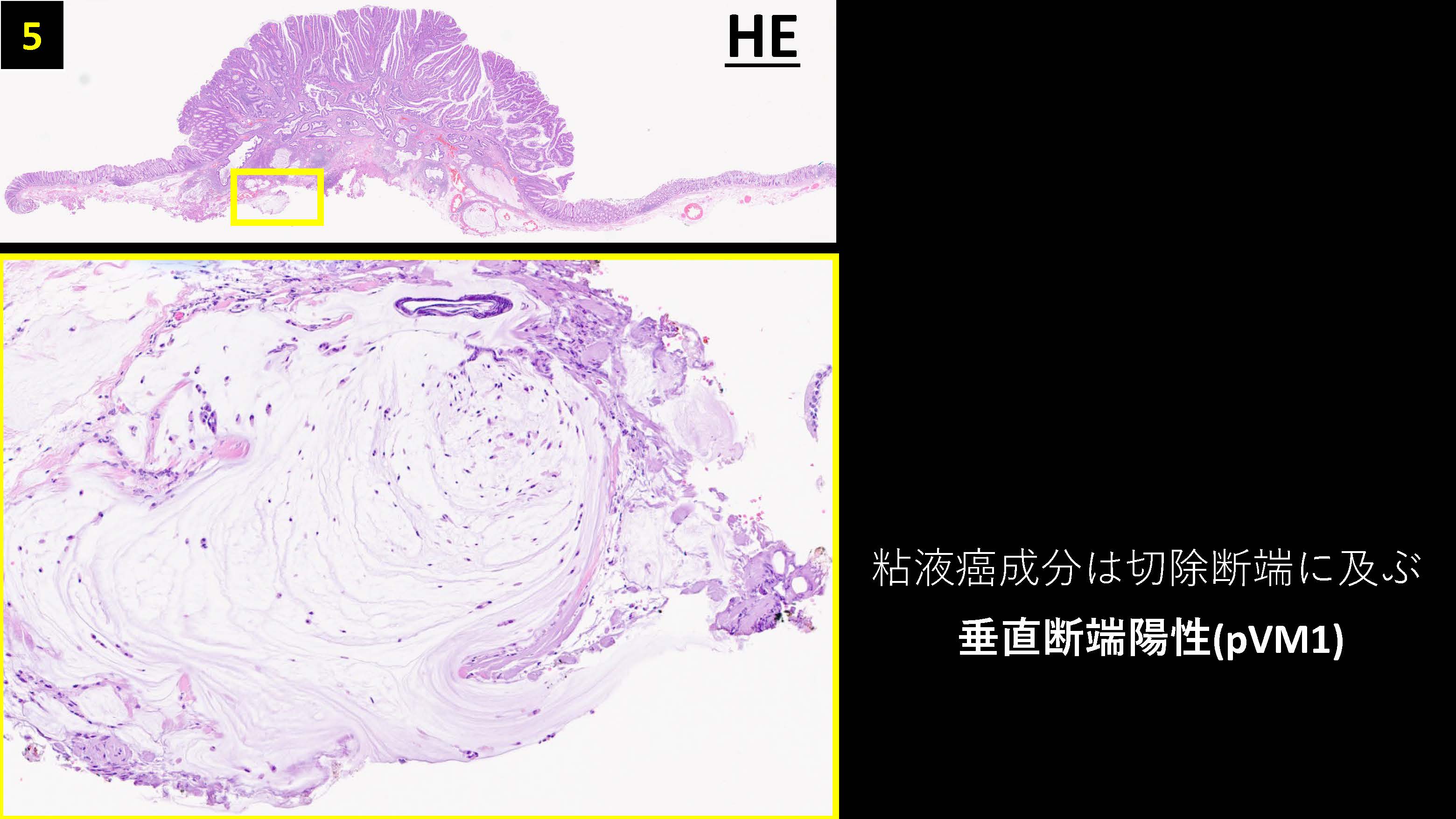 大腸041