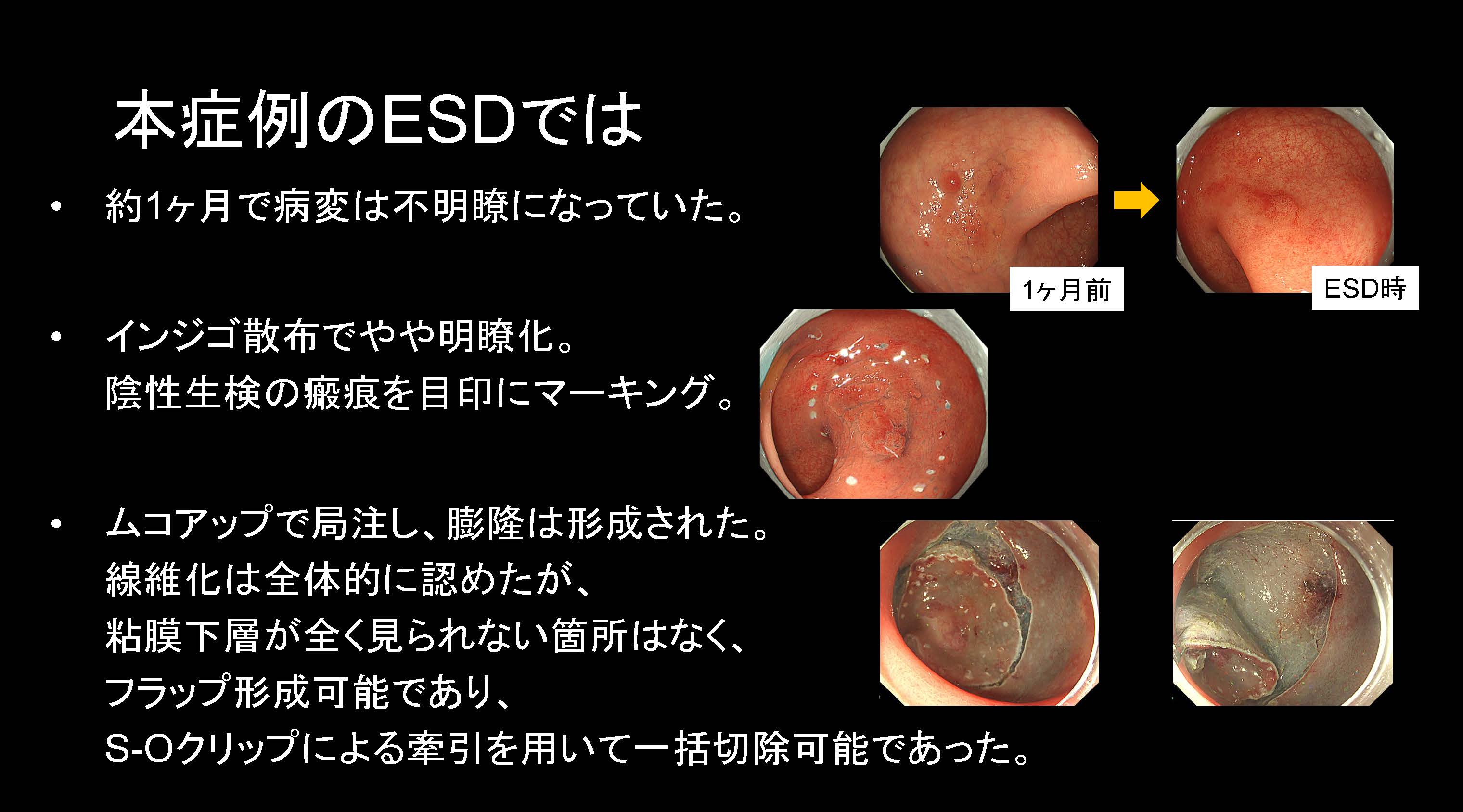 大腸046