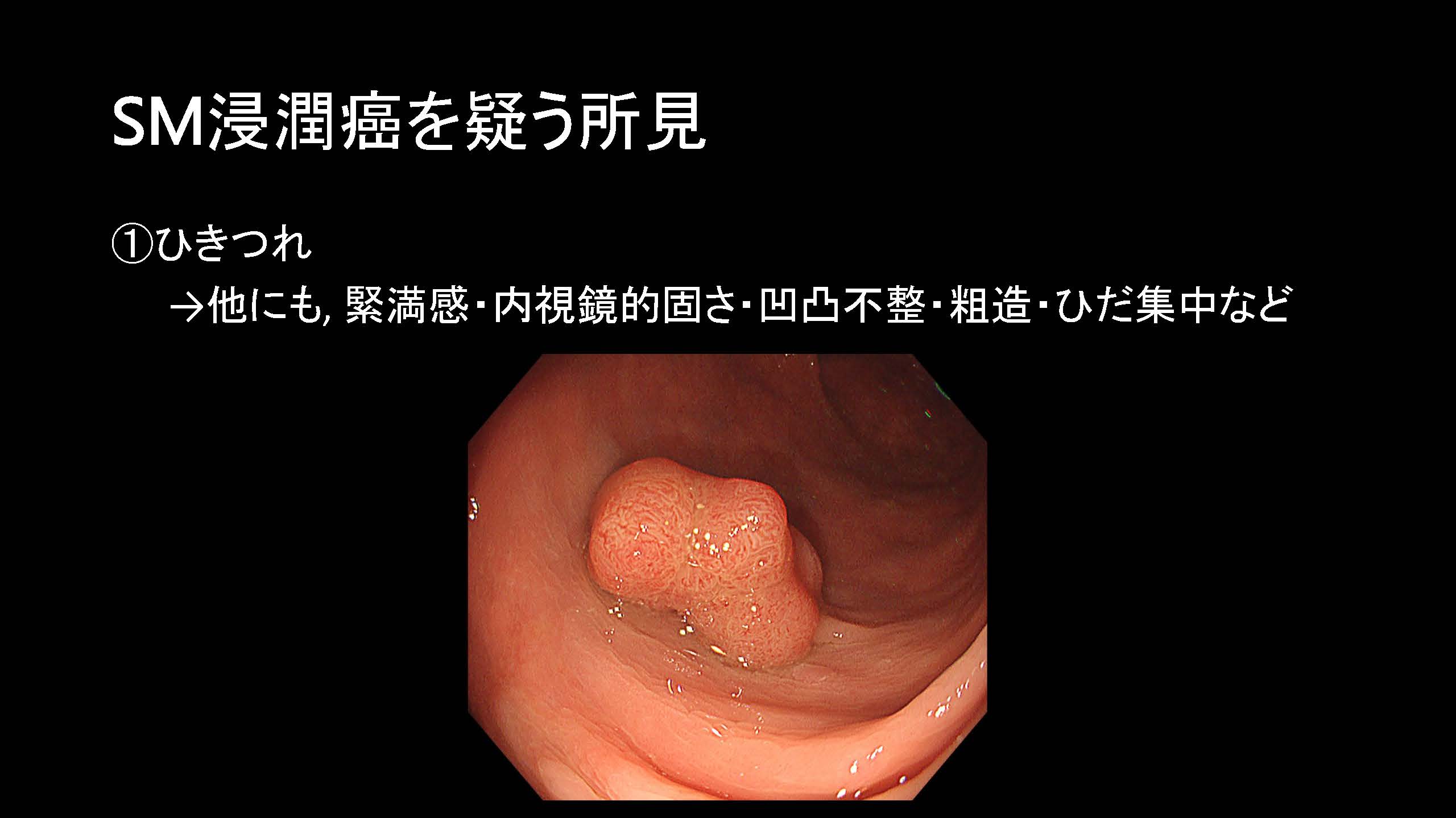 大腸070