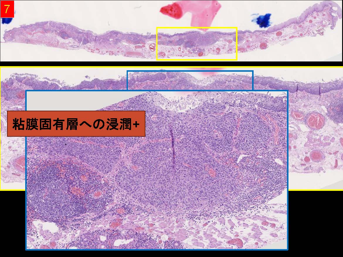 食道041