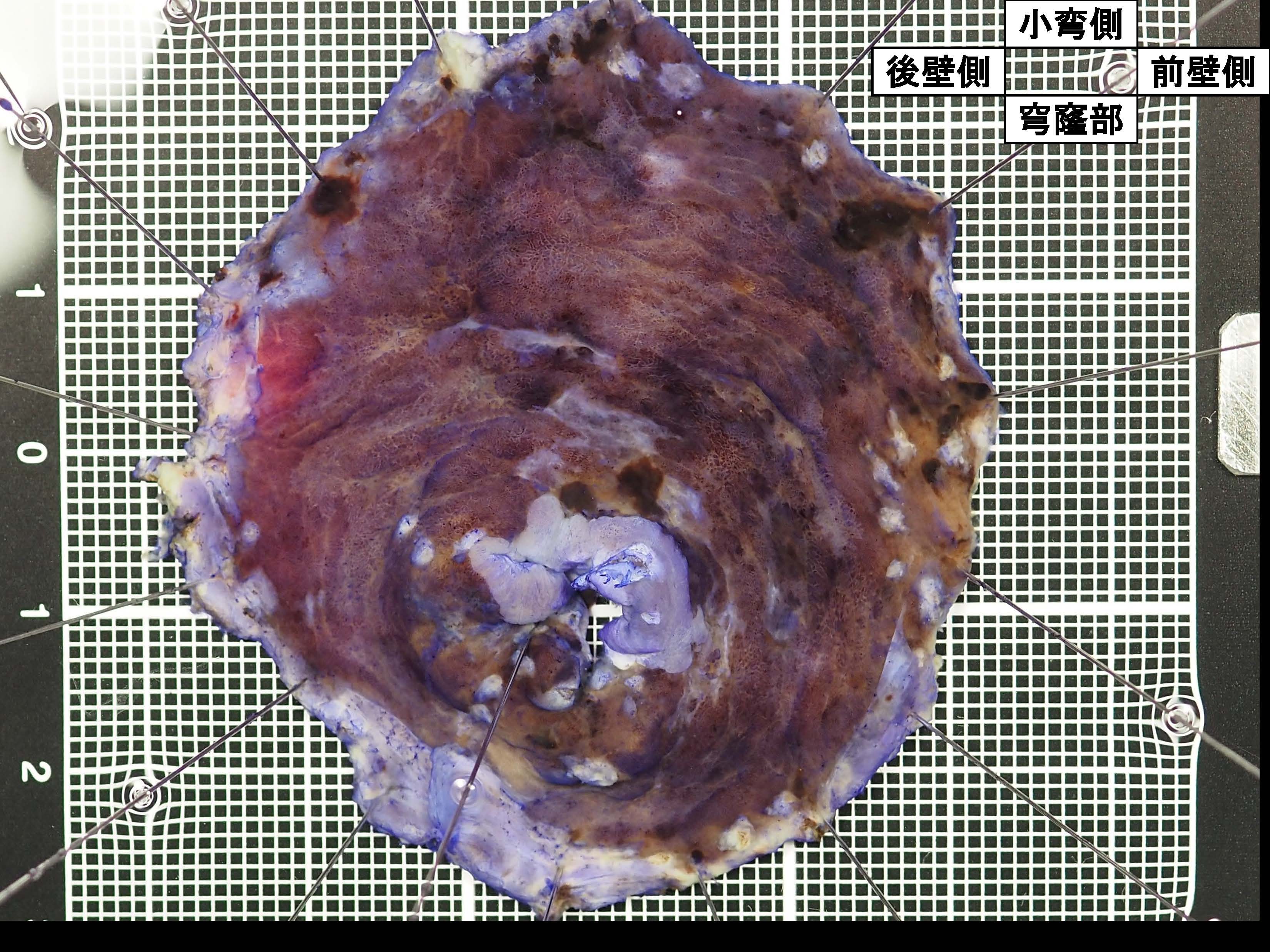 胃114