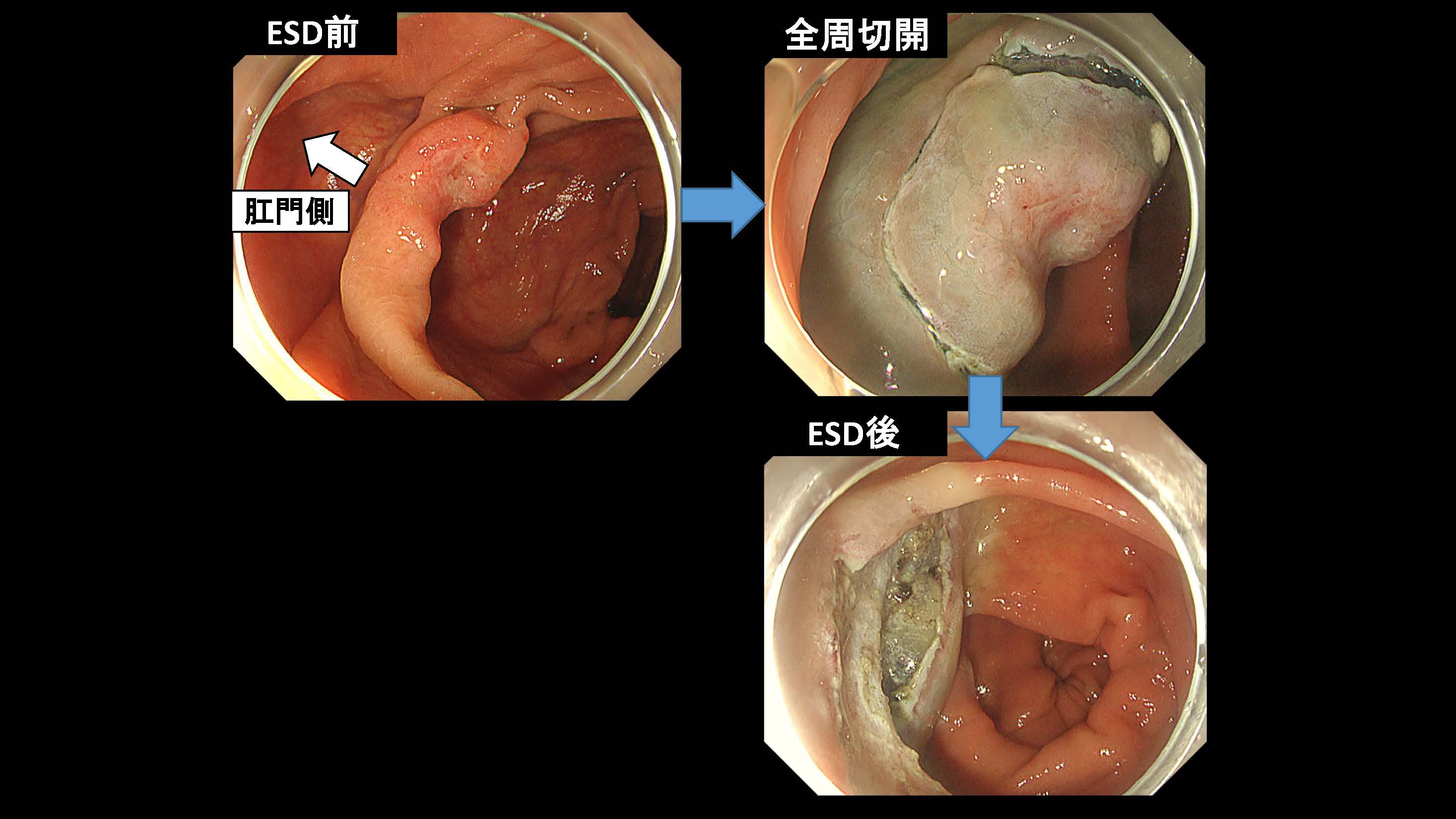 大腸023
