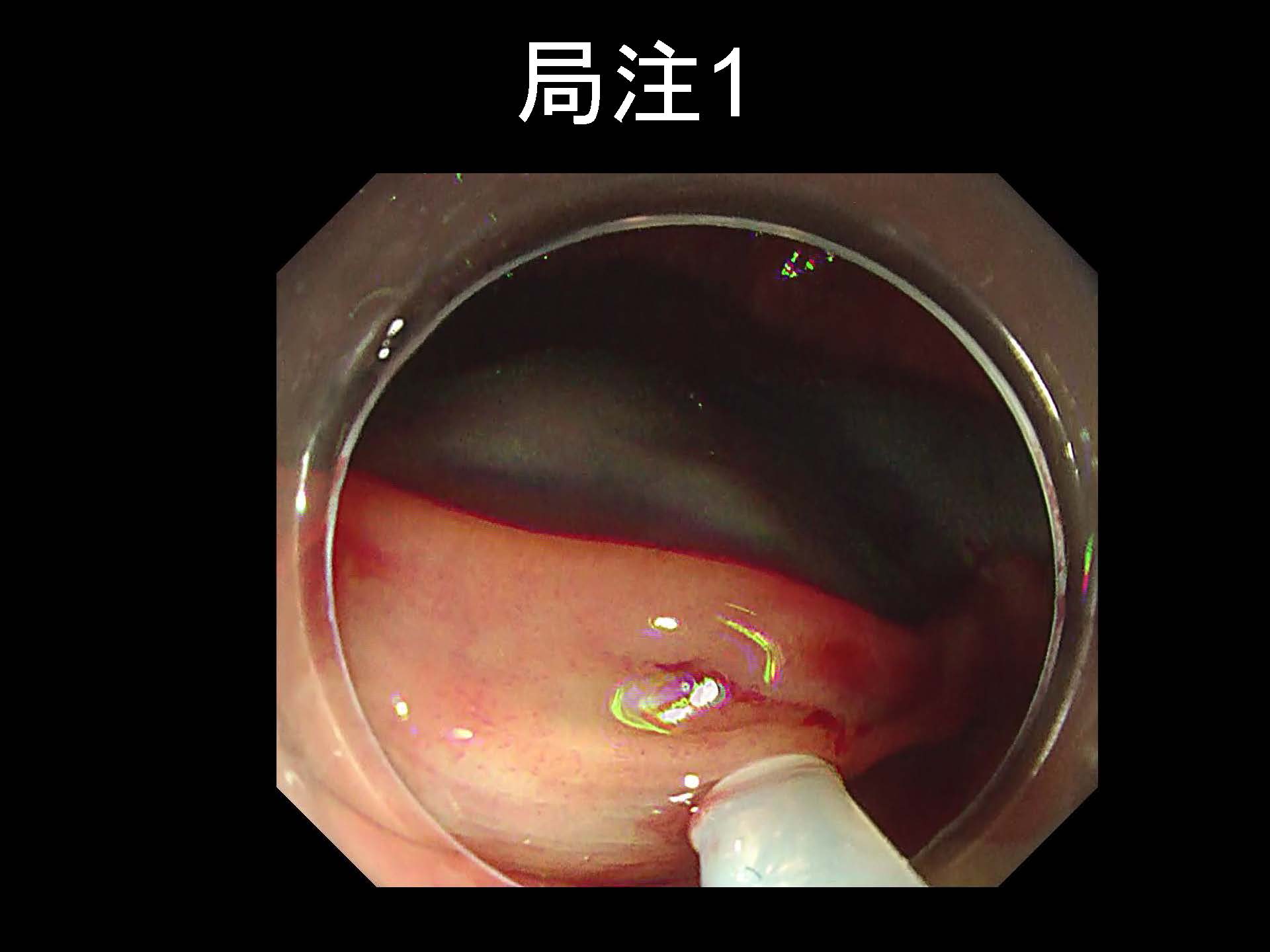 大腸018