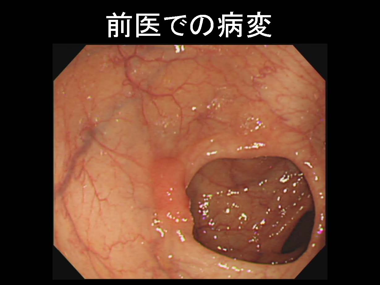 大腸059