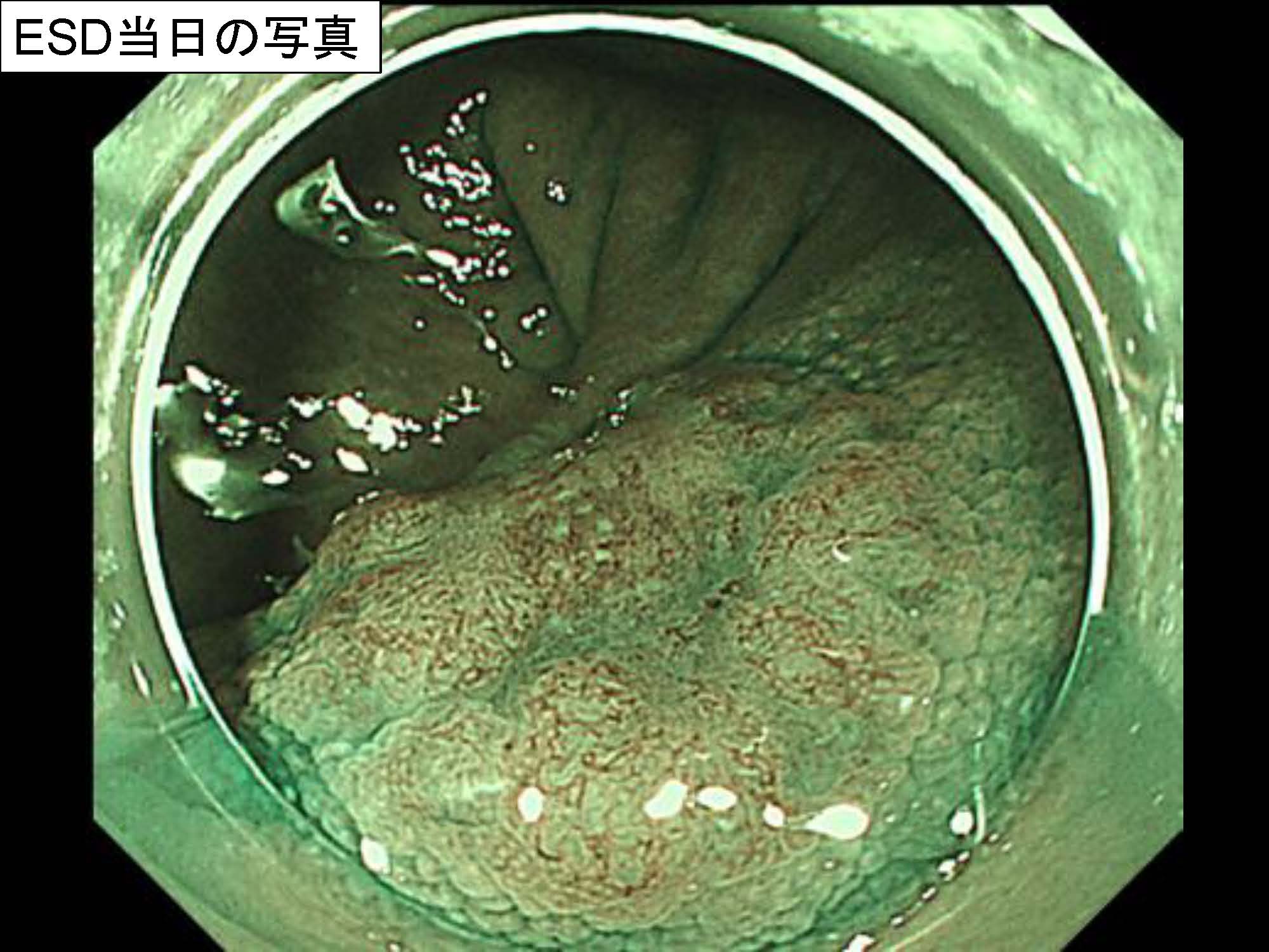 大腸013