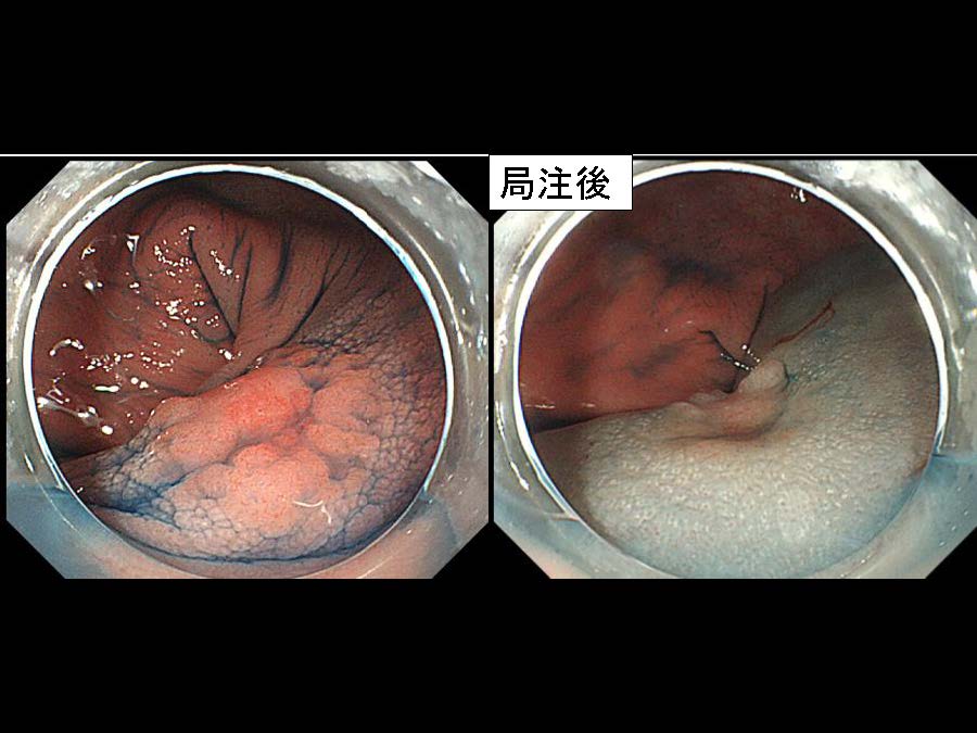 大腸019