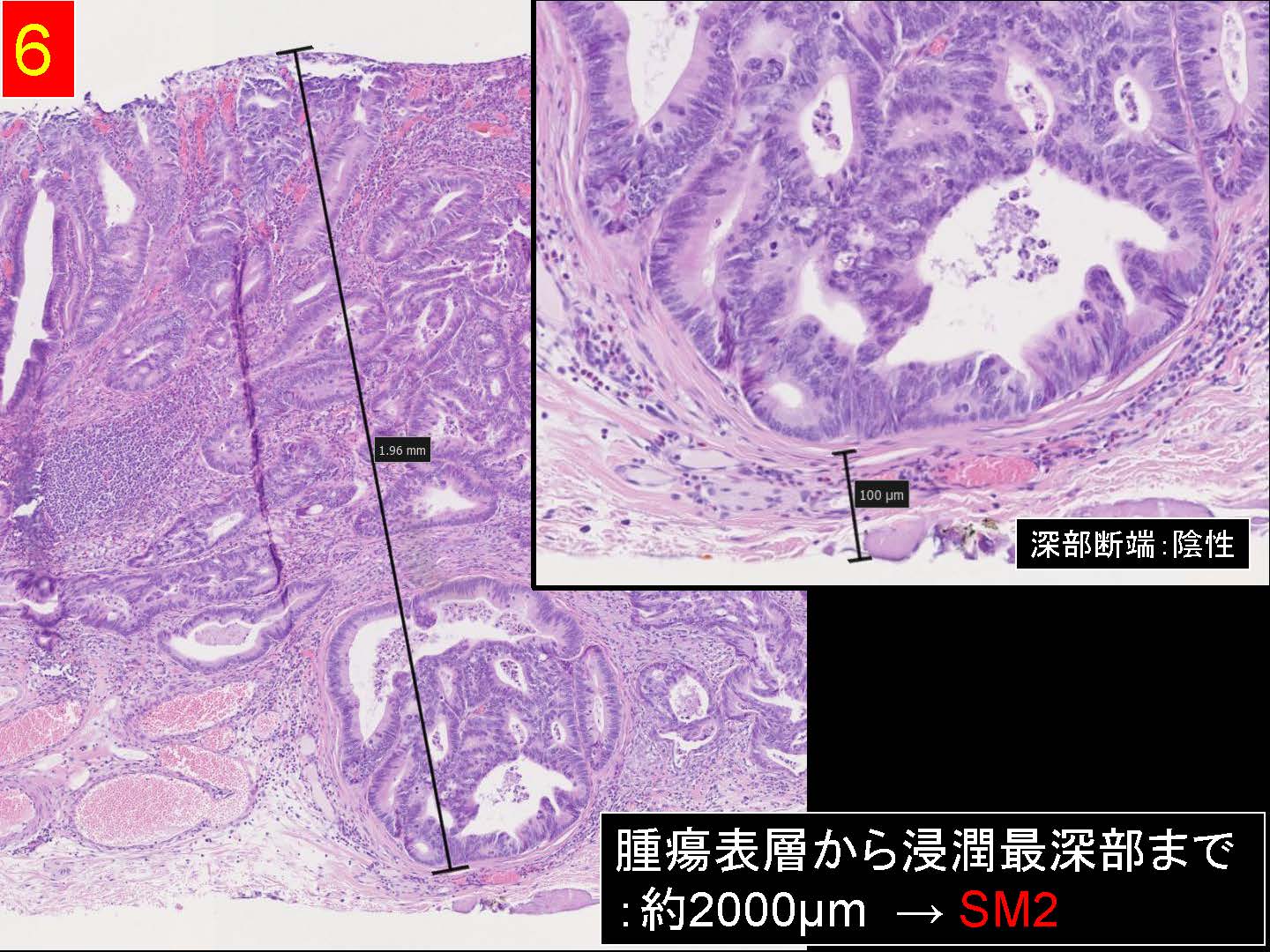 大腸048