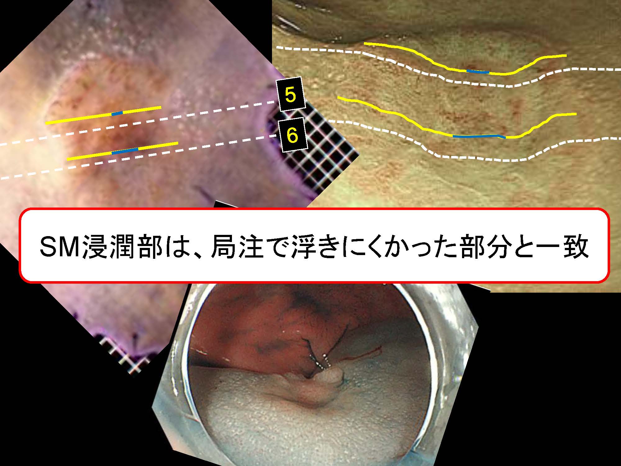 大腸062