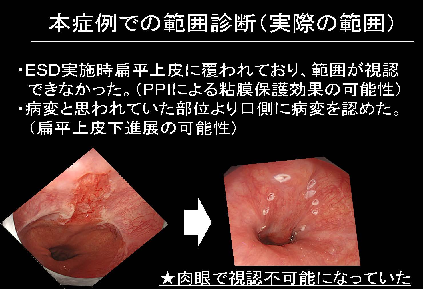 食道113