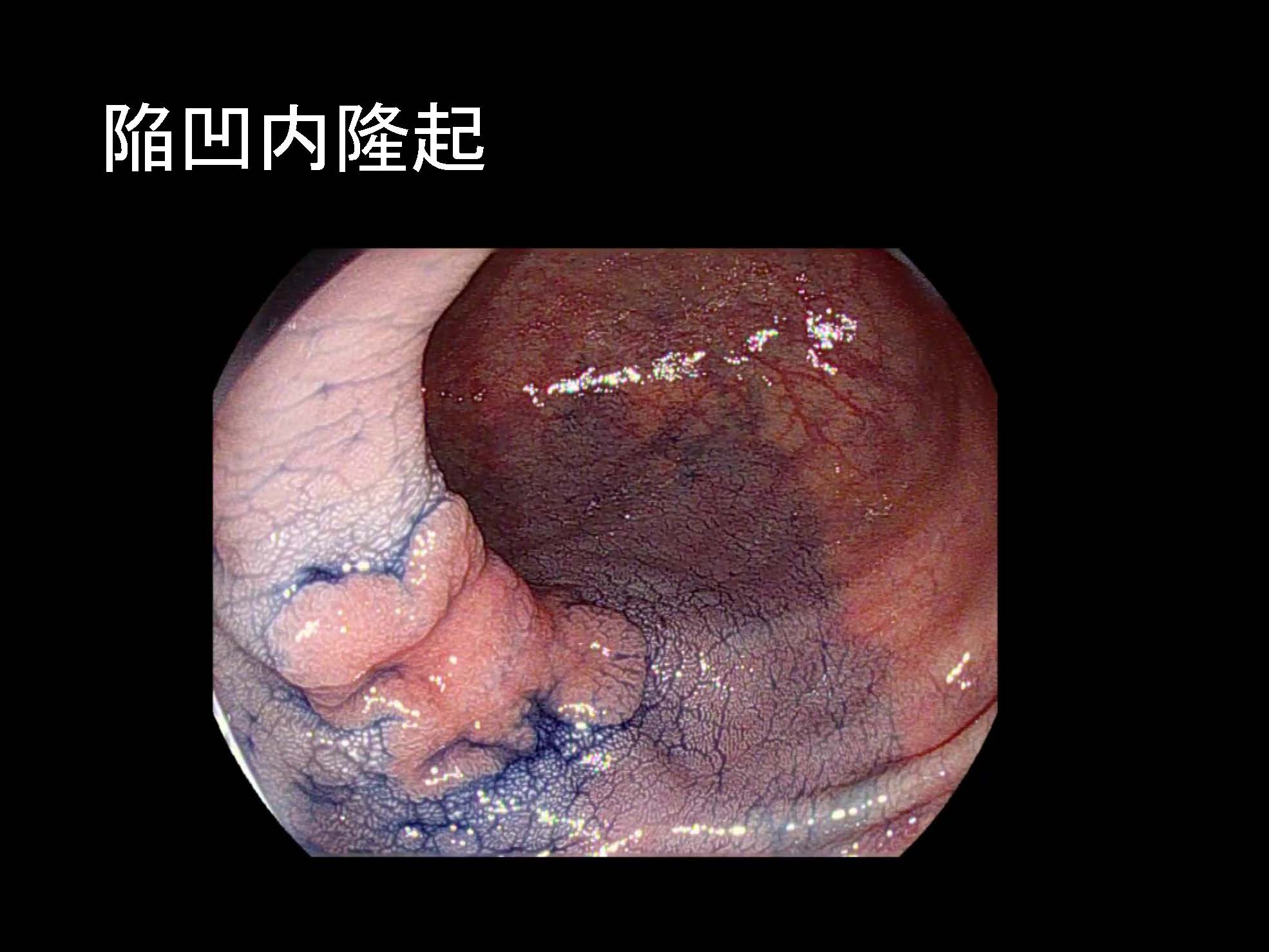大腸091