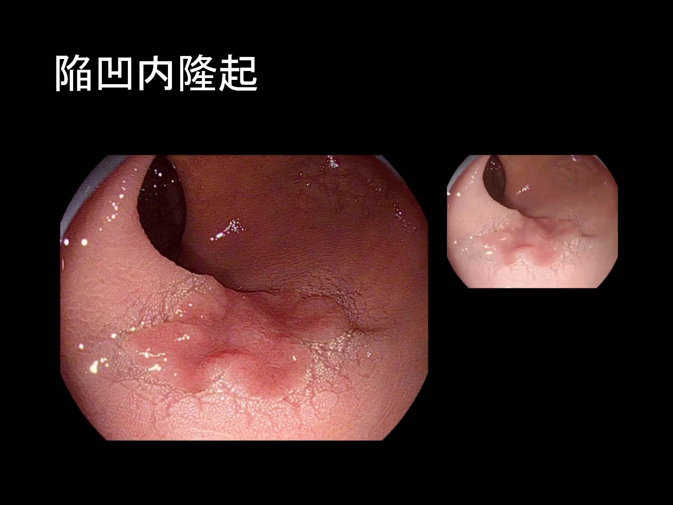 大腸092