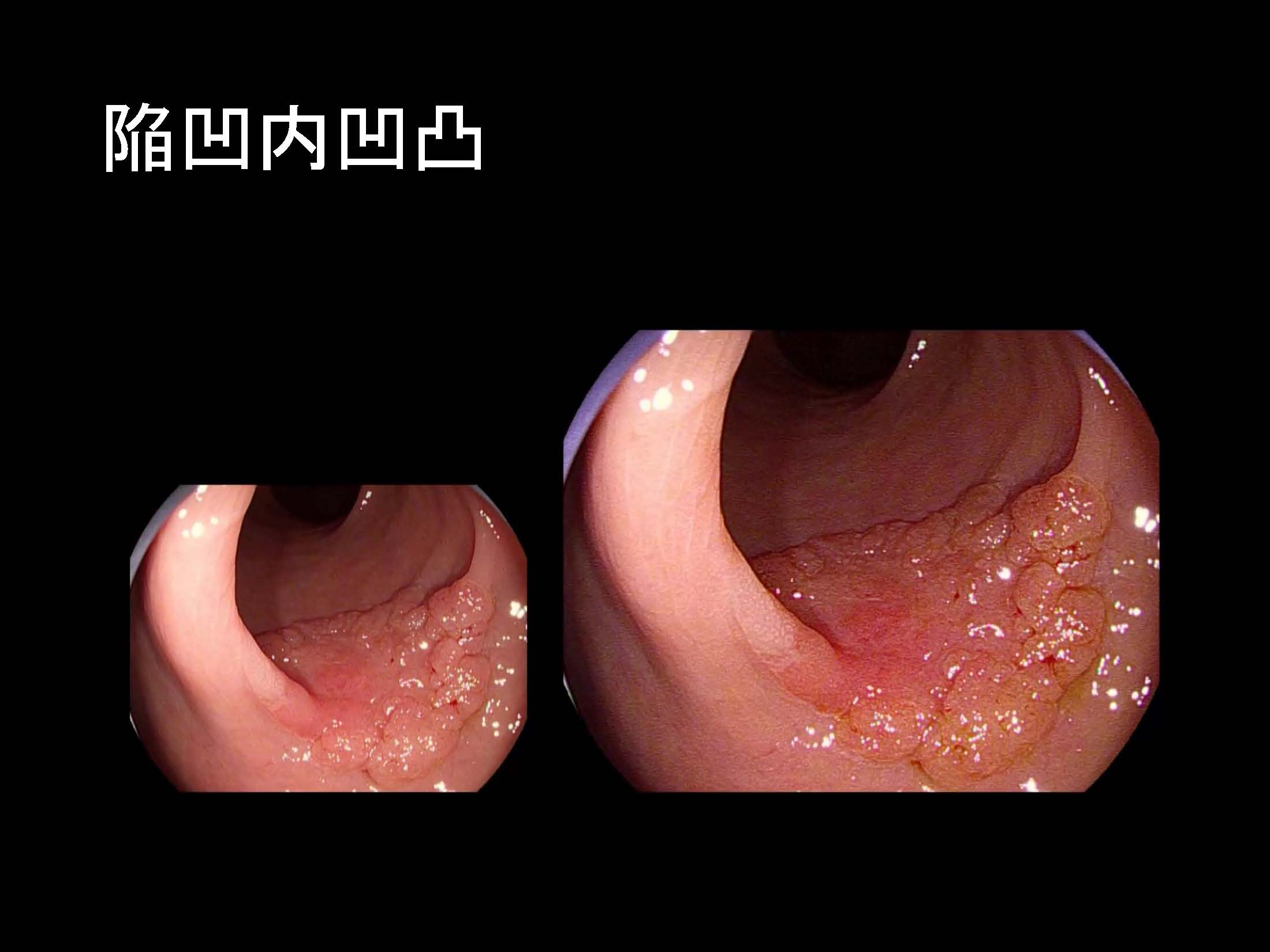 大腸093